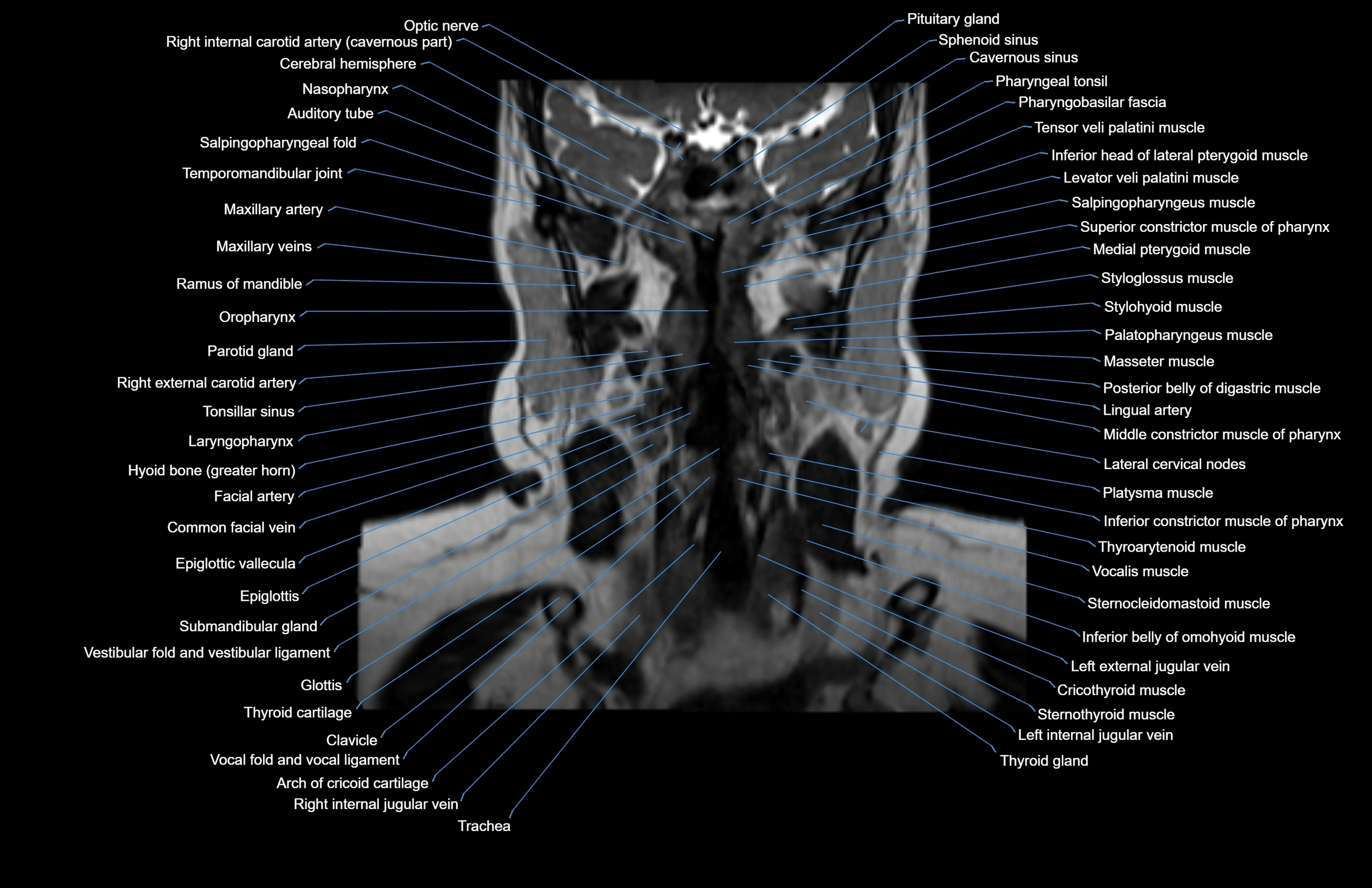 Neck coronal cross sectional MRI anatomy 3T MRI  image-img-00001-00042.webp
